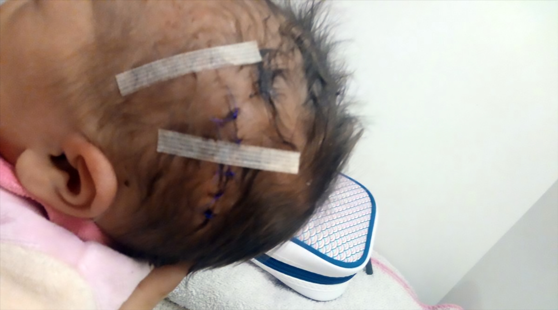 Afbeelding van Baby in hoofd gesneden tijdens keizersnede