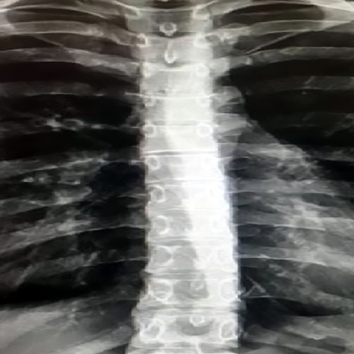 Afbeelding van Dochters tepelpiercings onthuld door röntgenscan